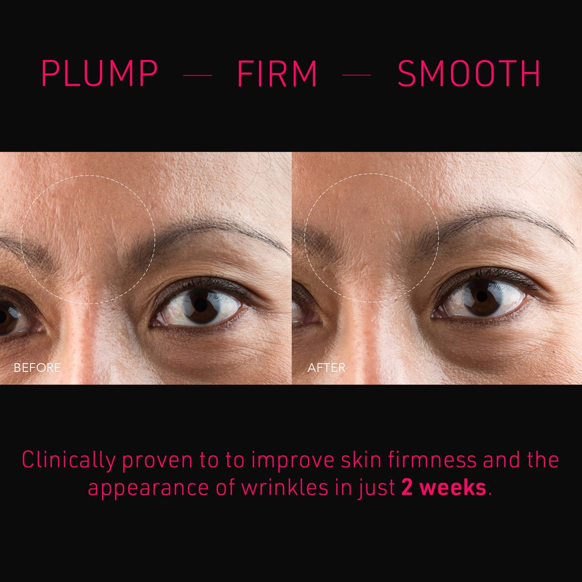 FAQ Microneedling Anti-Wrinkle Hyaluronic Acid Patches For Forehead