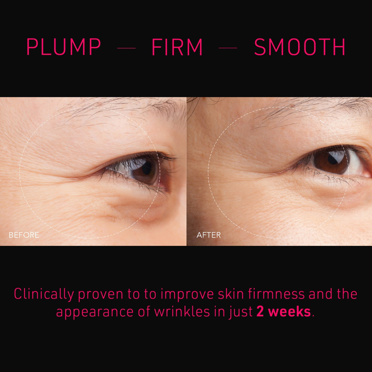 FAQ Microneedling Anti-Wrinkle Hyaluronic Acid Patches For Under Eyes